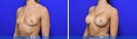 04 Subfascial / Prepectoral