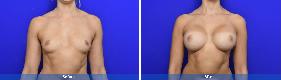 04 Subfascial / Prepectoral