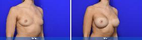 04 Subfascial / Prepectoral